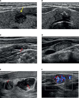 Nomograms Combining Ultrasonic Features With Clinical and Pathological Features for Estimation of Delphian Lymph Node Metastasis Risk in Papillary Thyroid Carcinoma